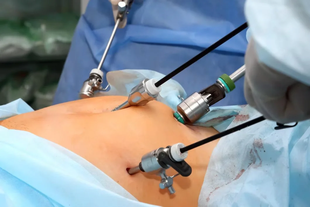 Laparoscopic Myomectomy